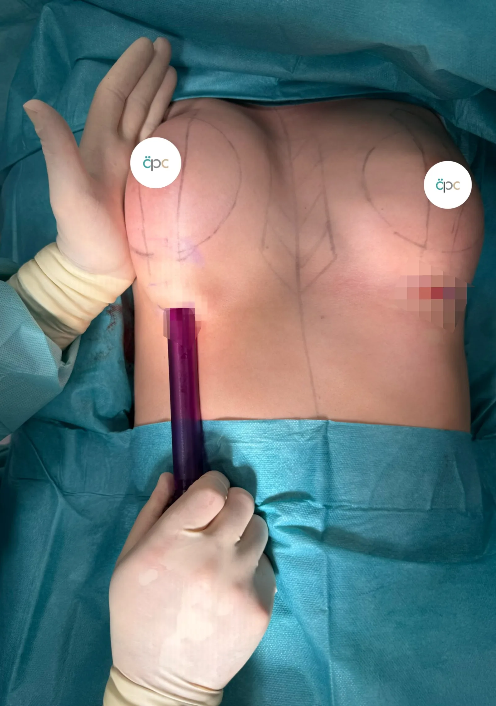 Intraoperative Aufnahme: Dr. Al-Shobash führt den Motiva Channel Separator über einen kleinen Schnitt ein